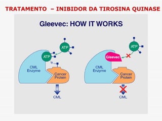 TRATAMENTO – INIBIDOR DA TIROSINA QUINASE
 