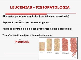 LEUCEMIAS - FISIOPATOLOGIA

Alterações genéticas adquiridas (numéricas ou estruturais)
               ↓
Expressão anormal dos proto oncogenes
               ↓
Perda de controle do ciclo cel (proliferação lenta e indefinida)
               ↓
Transformação malígna – dominância clonal
              ↓
            Neoplasia
 