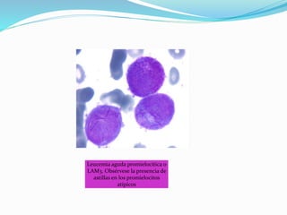 Leucemia aguda promielocítica o
LAM3. Obsérvese la presencia de
astillas en los promielocitos
atípicos
 