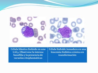 Célula blástica linfoide en una
LAL3. Obsérvese la intensa
basofilia y la presencia de
vacuolas citoplasmáticas
Célula linfoide inmadura en una
leucemia linfática crónica en
transformación
 