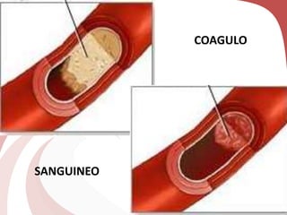 COAGULO
SANGUINEO
 