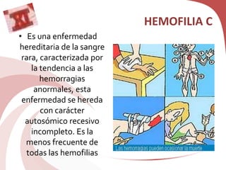 HEMOFILIA C
• Es una enfermedad
hereditaria de la sangre
rara, caracterizada por
la tendencia a las
hemorragias
anormales, esta
enfermedad se hereda
con carácter
autosómico recesivo
incompleto. Es la
menos frecuente de
todas las hemofilias
 