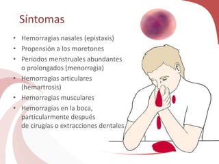 Síntomas
• Hemorragias nasales (epistaxis)
• Propensión a los moretones
• Periodos menstruales abundantes
o prolongados (menorragia)
• Hemorragias articulares
(hemartrosis)
• Hemorragias musculares
• Hemorragias en la boca,
particularmente después
de cirugías o extracciones dentales
 