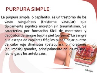 PURPURA SIMPLE
La púrpura simple, o capilaritis, es un trastorno de los
vasos sanguíneos (trastorno vascular) que
típicamente significa moretón sin traumatismo. Se
caracteriza por formación fácil de moretones y
depósitos de sangre bajo la piel (púrpura). La sangre
que escapa de capilares frágiles puede dejar puntos
de color rojo diminutos (petequias), o moretones
(equimosis) grandes, principalmente en los muslos,
las nalgas y los antebrazos.
 