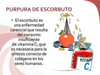 PURPURA DE ESCORBUTO
• El escorbuto es
una enfermedad
carencial que resulta
del consumo
insuficiente
de vitaminaC, que
es necesaria para la
síntesis correcta de
colágeno en los
seres humanos.
 