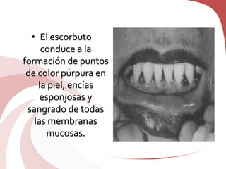 • El escorbuto
conduce a la
formación de puntos
de color púrpura en
la piel, encías
esponjosas y
sangrado de todas
las membranas
mucosas.
 