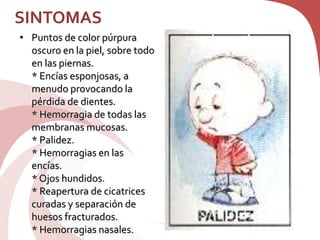 SINTOMAS
• Puntos de color púrpura
oscuro en la piel, sobre todo
en las piernas.
* Encías esponjosas, a
menudo provocando la
pérdida de dientes.
* Hemorragia de todas las
membranas mucosas.
* Palidez.
* Hemorragias en las
encías.
* Ojos hundidos.
* Reapertura de cicatrices
curadas y separación de
huesos fracturados.
* Hemorragias nasales.
 