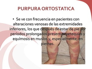 PURPURA ORTOSTATICA
• Se ve con frecuencia en pacientes con
alteraciones venosas de las extremidades
inferiores, los que después de estar de pie por
períodos prolongados presentan petequias y
equímosis en muslos y, especialmente, en
piernas.
 