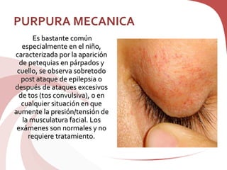 PURPURA MECANICA
Es bastante común
especialmente en el niño,
caracterizada por la aparición
de petequias en párpados y
cuello, se observa sobretodo
post ataque de epilepsia o
después de ataques excesivos
de tos (tos convulsiva), o en
cualquier situación en que
aumente la presión/tensión de
la musculatura facial. Los
exámenes son normales y no
requiere tratamiento.
 