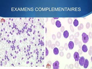 EXAMENS COMPLEMENTAIRES
a) Hémogramme :
-Hyperleucocytose 50 000 a 100 000 GB/mm3
avec hyperlymphocytose sanguine
-Anémie , Thrombopénie
b) Frottis sanguin :proliferation cellulaire
monomorphe faite de petits lymphocytes proche
du lymphocyte normal ,avec presence d’ombre de
Gumprecht
 