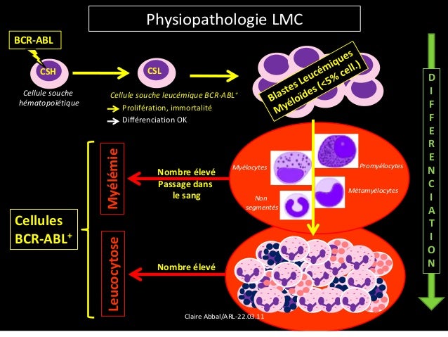 Leucemie Myeloide Chronique : LEUCEMIE MYELOIDE CHRONIQUE PDF - C92.1 ...