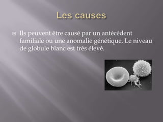 Les causesIls peuvent être causé par un antécédent familiale ou une anomalie génétique. Le niveau de globule blanc est très élevé.