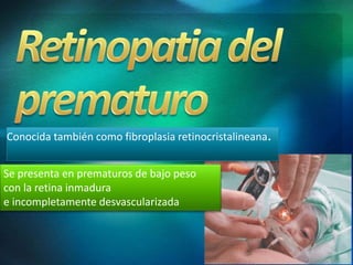 Conocida también como fibroplasia retinocristalineana.
Se presenta en prematuros de bajo peso
con la retina inmadura
e incompletamente desvascularizada
 