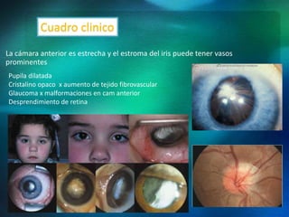 La cámara anterior es estrecha y el estroma del iris puede tener vasos
prominentes
Pupila dilatada
Cristalino opaco x aumento de tejido fibrovascular
Glaucoma x malformaciones en cam anterior
Desprendimiento de retina
Cuadro clinico
 
