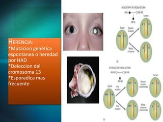 HERENCIA:
*Mutacion genética
espontanea o heredad
por HAD
*Deleccion del
cromosoma 13
*Esporadica mas
frecuente
 