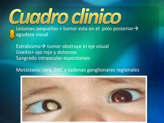 Lesiones pequeñas + tumor esta en el polo posterior
agudeza visual
Estrabismo tumor obstruye el eje visual
Uveítis+ ojo rojo y doloroso
Sangrado intraocular espontaneo
Metástasis: rara, SNC y cadenas ganglionares regionales
 