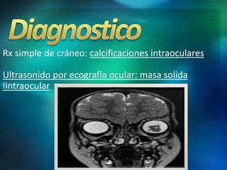 Rx simple de cráneo: calcificaciones intraoculares
Ultrasonido por ecografía ocular: masa solida
Iintraocular
 