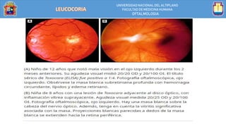 UNIVERSIDAD NACIONALDEL ALTIPLANO
FACULTAD DE MEDICINA HUMANA
OFTALMOLOGIA
 