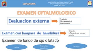 UNIVERSIDAD NACIONALDEL ALTIPLANO
FACULTAD DE MEDICINA HUMANA
OFTALMOLOGIA
Proptosis
Edema palpebral
linfadenopatia
Cataratas
Inflamación de cámara
anterior
Examen de fondo de ojo dilatado
retina
Anomalias
vasculares
tumores
 