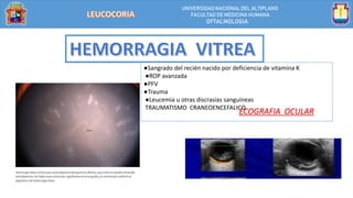 UNIVERSIDAD NACIONALDEL ALTIPLANO
FACULTAD DE MEDICINA HUMANA
OFTALMOLOGIA
●Sangrado del recién nacido por deficiencia de vitamina K
●ROP avanzada
●PFV
●Trauma
●Leucemia u otras discrasias sanguíneas
TRAUMATISMO CRANEOENCEFALICO
ECOGRAFIA OCULAR
 