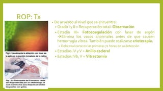 ROP:Tx
• De acuerdo al nivel que se encuentra:
• Grado I y II = Recuperación total. Observación
• Estadio III= Fotocoagulación con laser de argón
Elimina los vasos anormales antes de que causen
hemorragia vítrea.También puede realizarse crioterapia.
• Debe realizarse en las primeras 72 horas de su detección
• Estadios IV yV = Anillo escleral
• Estadios IVb,V = Vitrectomia
 