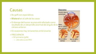 Causas
• 80-90% son esporádicos
• Bilateral en el 70% de los casos
• El drenaje del humor acuoso está afectado como
resultado de un desarrollo anormal del ángulo de la
cámara anterior.
• En ocasiones hay remanentes embrionarios
• FRECUENCIA
• GC primario (50%)
• 1 de cada 10,000 RNV
 
