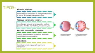 TIPOS: Aislado o primitivo:
Restos de tejido embrionario en el ángulo: Membrana
de Barkan  Impide el drenaje del acuoso.
Asociado a anomalías oculares:
Anomalías que secundariamente pueden producir
glaucoma: Aniridia, microftalmos, microcórnea, etc.
Asociado a anomalías sistémicas:
Generan glaucoma tardío: Sx. Marfan, anomalías
metabólicas, cromosomopatías.
Secundario:
No existe anomalía angular:Vítreo primario
hiperplásico.
 