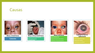 Causas
Catarata
Masa cristaliniana
Vítreo primario persistente
Retinopatia de la
prematuridad
Masa retrocristaliniana
Retinoblastoma
Despredimiento de retina
Parásitos (Toxocara canis)
Masa retiniana
Enfermedad de Coats
Fiabras de mielina
Colobomas coroideos
Superficie blanca
reflectante
 