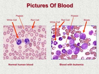 Pictures Of Blood
Normal human blood
White Cell Red Cell
Platelet
Blood with leukemia
BlastsRed Cell
Platelet
White Cell
 