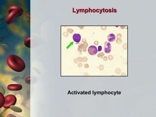 Activated lymphocyte
Lymphocytosis
 