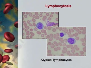 Atypical lymphocytes
Lymphocytosis
 