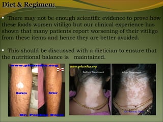 Diet & Regimen:

• There may not be enough scientific evidence to prove how
these foods worsen vitiligo but our clinical experience has
shown that many patients report worsening of their vitiligo
from these items and hence they are better avoided.

• This should be discussed with a dietician to ensure that
the nutritional balance is maintained.
 