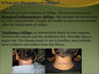What are the types of vitiligo?

There are several variations of vitiligo. The most common are:
Marginal inflammatory vitiligo—the macules are surrounded
by a red, raised border. Usually the border is seen several months
after the initial onset of vitiligo.

Trachoma vitiligo: an intermediate shade of color appears
between the macula and the unaffected skin. Heredity plays a
major role. The disease tends to run in families, most patients
have a relative who suffers from this illness.
 