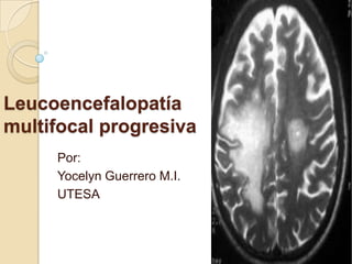 Leucoencefalopatía
multifocal progresiva
Por:
Yocelyn Guerrero M.I.
UTESA
 