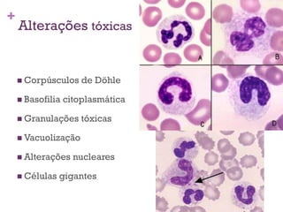 +
    Alterações tóxicas


     Corpúsculos     de Döhle

     Basofilia   citoplasmática

     Granulações     tóxicas

     Vacuolização

     Alterações    nucleares

     Células   gigantes
 
