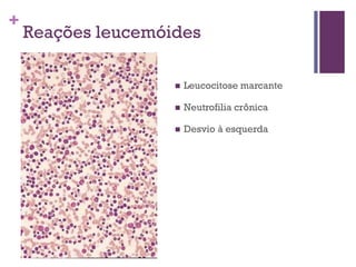 +
    Reações leucemóides

                       Leucocitose marcante

                       Neutrofilia crônica

                       Desvio à esquerda
 