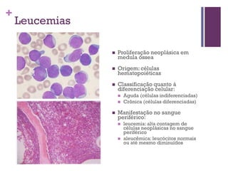 +
    Leucemias

                   Proliferação neoplásica em
                    medula óssea
                   Origem: células
                    hematopoiéticas
                   Classificação quanto à
                    diferenciação celular:
                       Aguda (células indiferenciadas)
                       Crônica (células diferenciadas)

                   Manifestação no sangue
                    periférico:
                       leucemia: alta contagem de
                        células neoplásicas no sangue
                        periférico
                       aleucêmica: leucócitos normais
                        ou até mesmo diminuídos
 