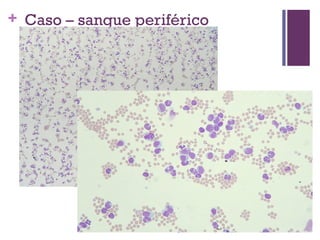 + Caso – sangue periférico
  clínico
 