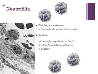 +
    Neutrofilia


                     Fisiológica: estresse
                         liberação de adrenalina/cortisol

                     Reativa:

                      inflamação aguda ou crônica
                         infecções (sistêmicas/locais)
                         necrose
 