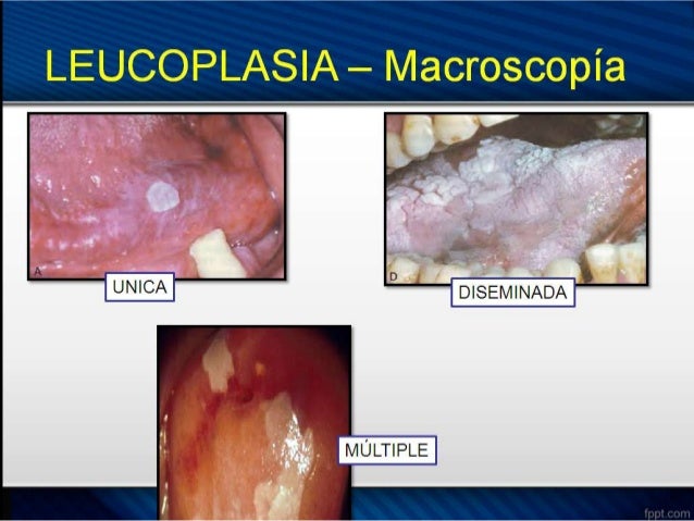 LEUCOPLASIA - Revision
