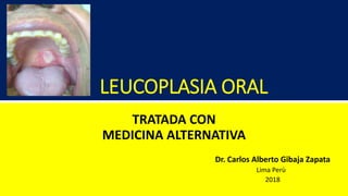 LEUCOPLASIA ORAL
TRATADA CON
MEDICINA ALTERNATIVA
Dr. Carlos Alberto Gibaja Zapata
Lima Perù
2018
 