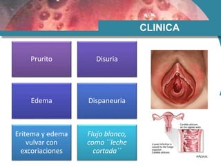 CLINICA
Prurito Disuria
Edema Dispaneuria
Eritema y edema
vulvar con
excoriaciones
Flujo blanco,
como ´´leche
cortada´´
 