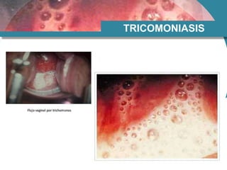 TRICOMONIASIS
 