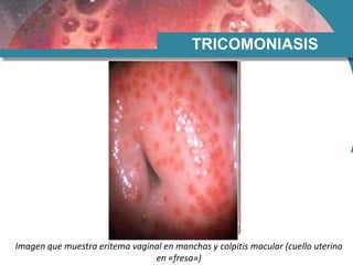 TRICOMONIASIS
Imagen que muestra eritema vaginal en manchas y colpitis macular (cuello uterino
en «fresa»)
 