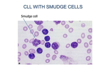CLL WITH SMUDGE CELLS
Smudge cell
 