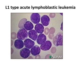 L1 type acute lymphoblastic leukemia
 