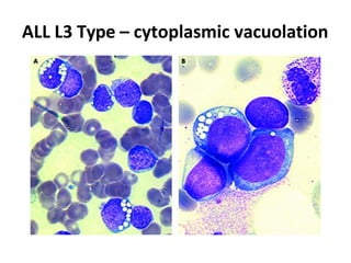 ALL L3 Type – cytoplasmic vacuolation
 