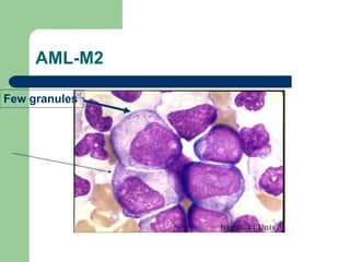 AML-M2
Few granules
 