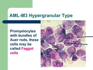 AML-M3 Hypergranular Type
Promyelocytes
with bundles of
Auer rods, these
cells may be
called Faggot
cells
 