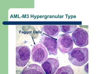 AML-M3 Hypergranular Type
Faggot Cells
 
